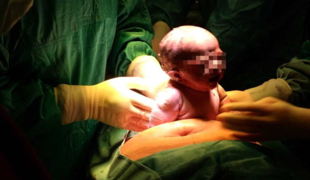 Primo parto cesareo&quot;dolce&quot; all'ospedale di San Donà